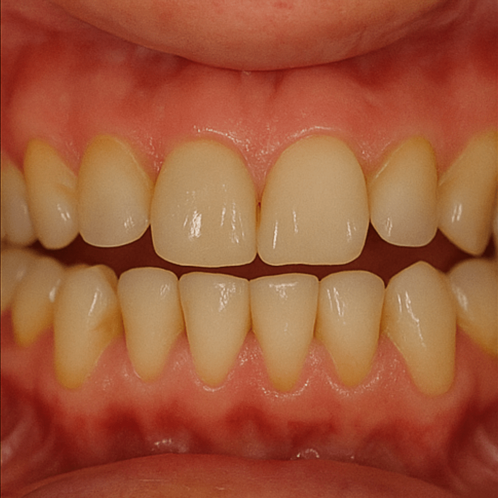 Reabilitacao com implantes antes